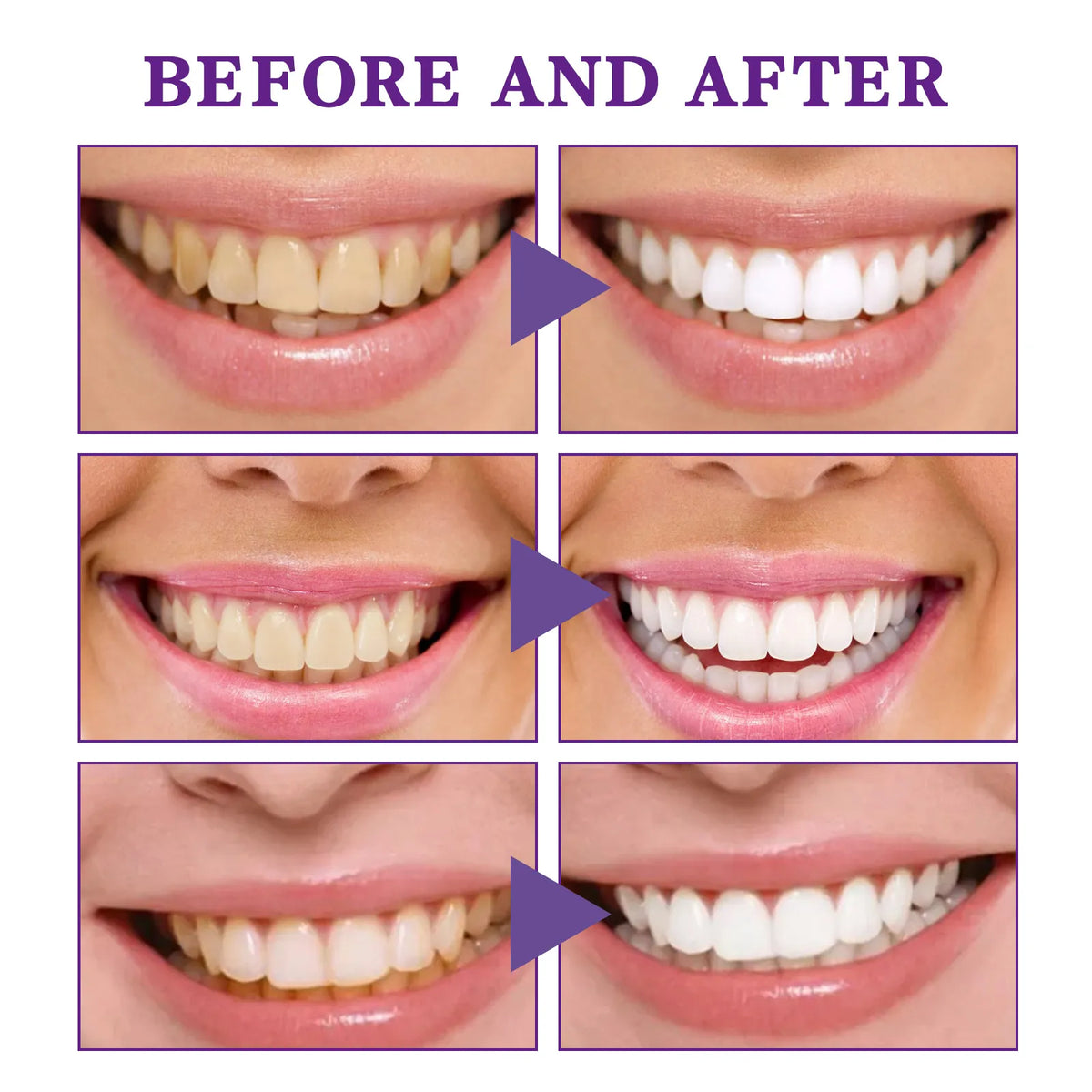 Before and after comparison of teeth whitening with a purple triangle pointing to the 'after' images.